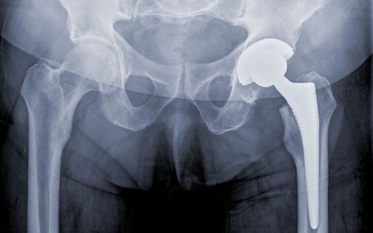 Imagem de Radiografia de prótese do quadril