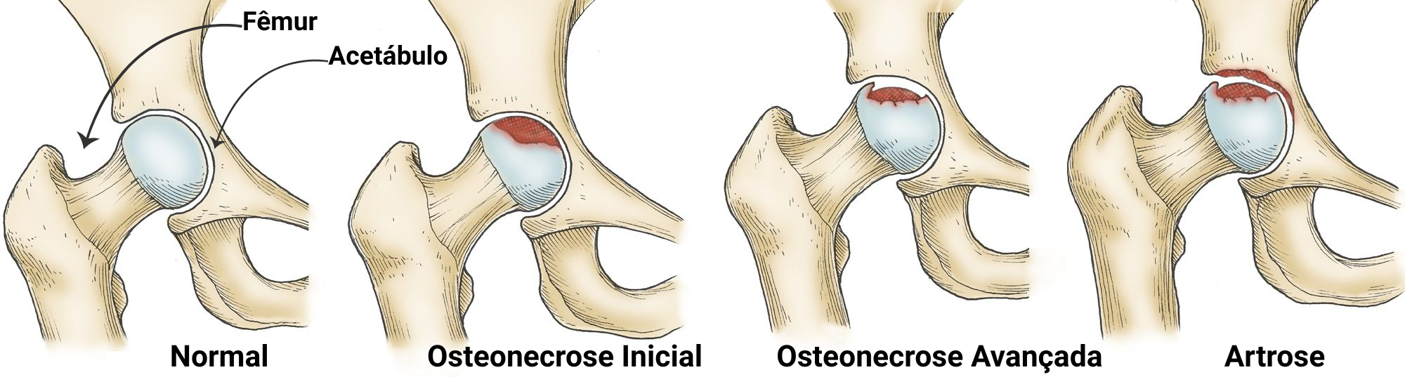 Osteonecrose da Cabeça Femoral: Sintomas e Tratamento RJ