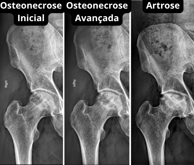 Osteonecrose da Cabeça Femoral: Sintomas e Tratamento RJ